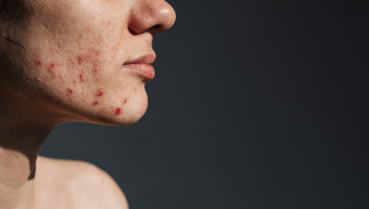 Acne-Prone Skin