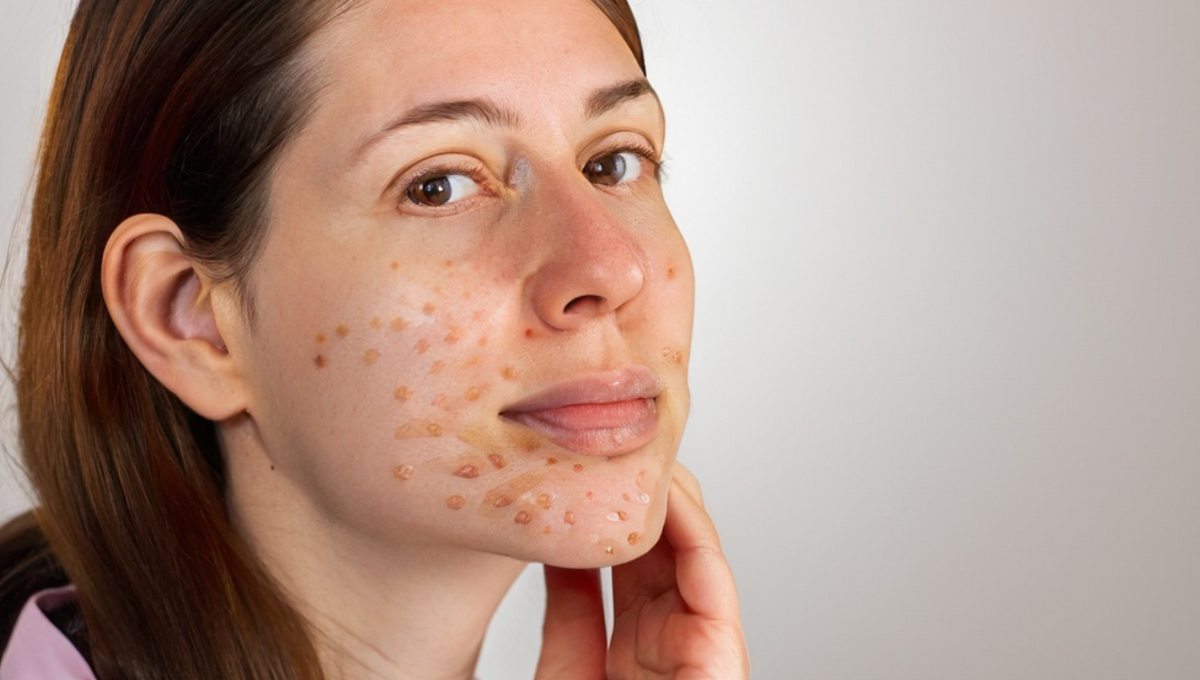 acne scars
