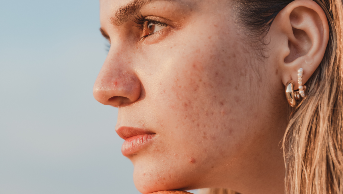 Avoid These Hormonal Acne Triggers