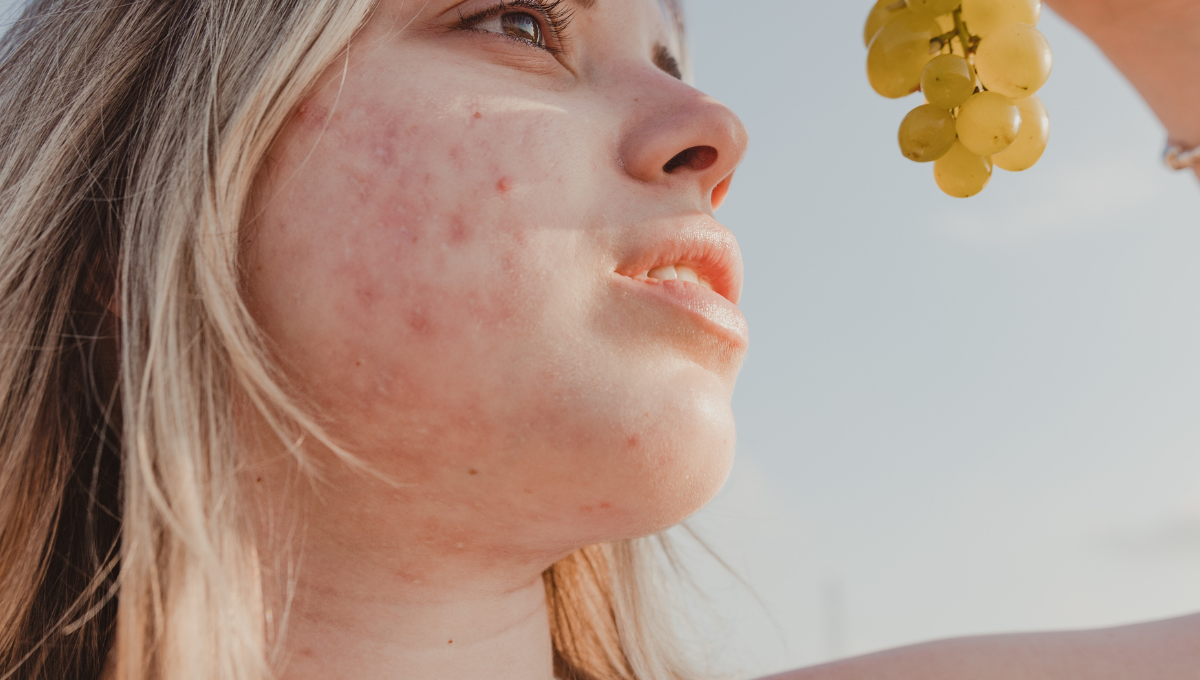 Best Supplements for Hormonal Acne Relief