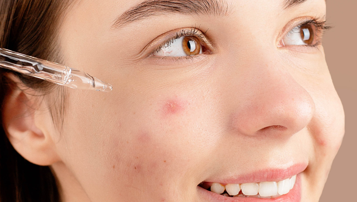 Best Treatments for Hormonal Acne
