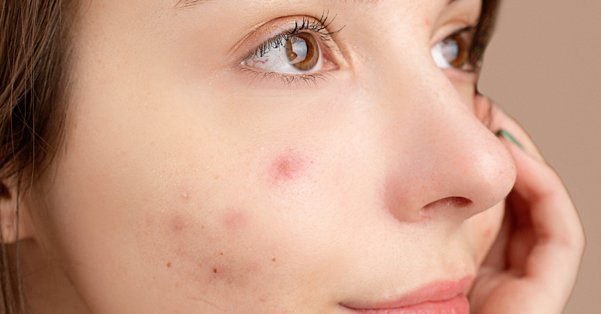 What Really Causes Cystic Acne and Why It Keeps Coming Back?
