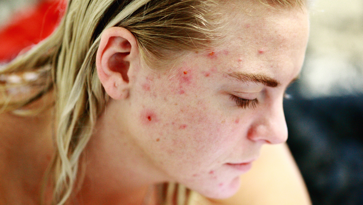 Does Accutane Work for Teen Acne