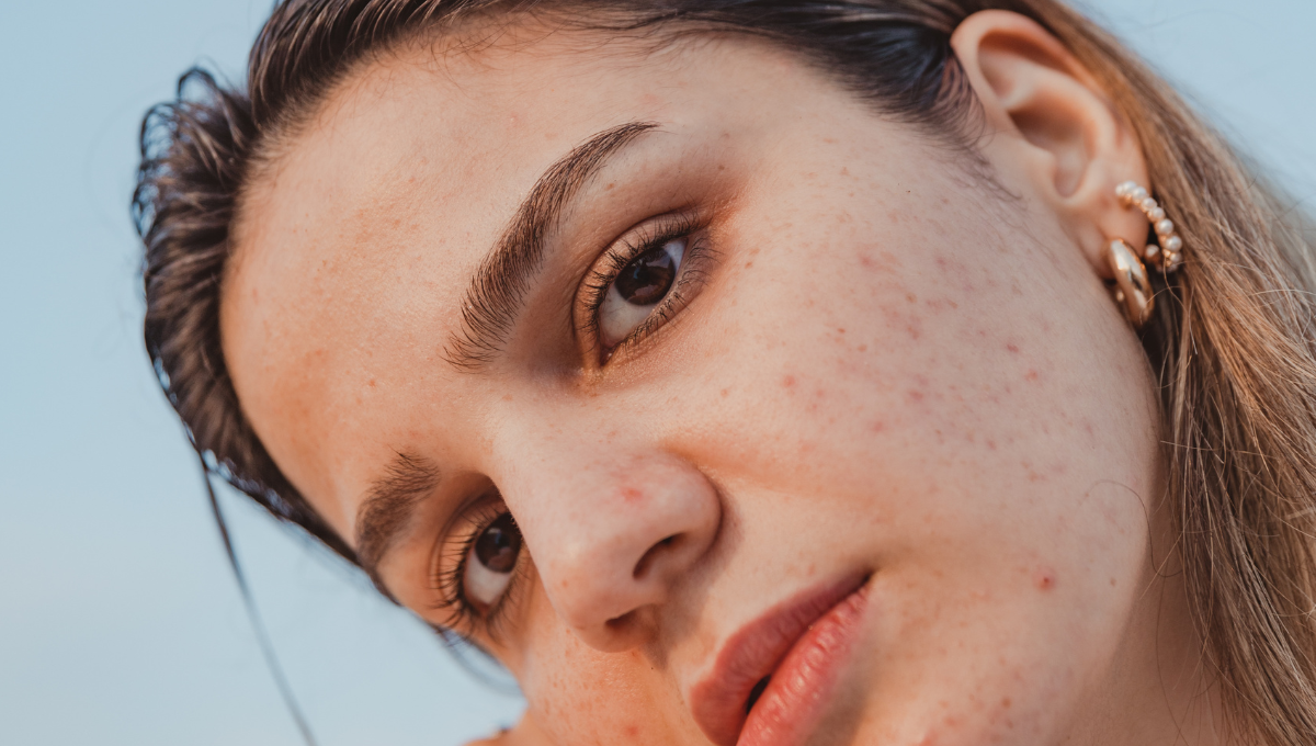 Fix Hormonal Acne by Improving Your Sleep