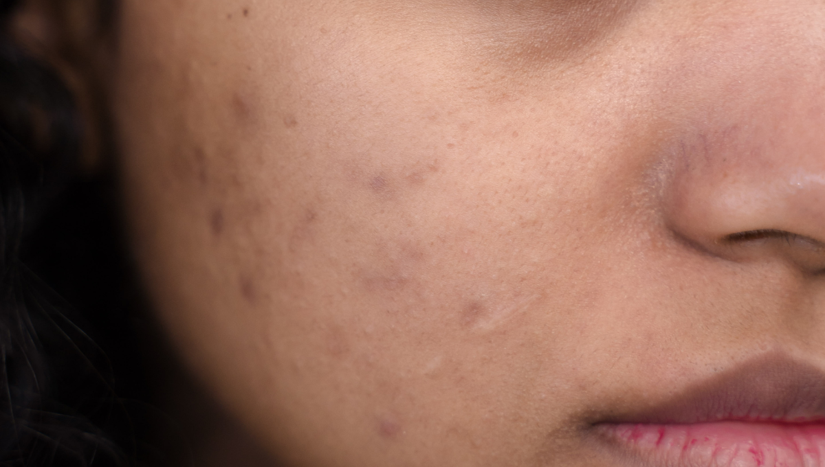Fungal Acne
