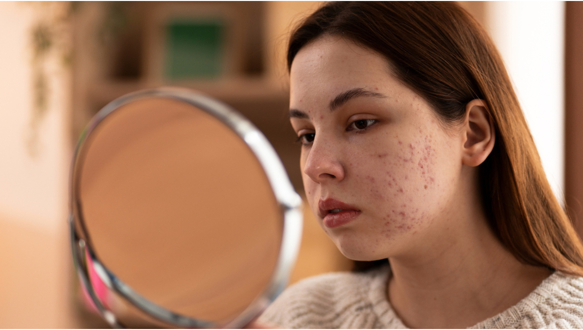 fungal acne