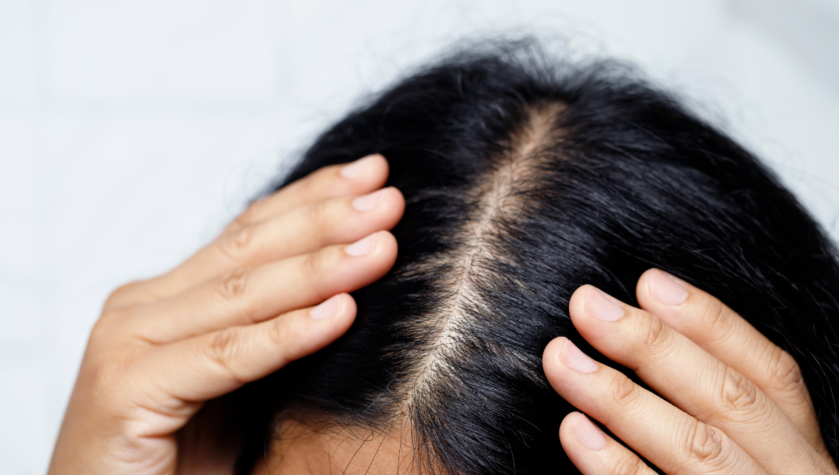 Causes of Hair Loss