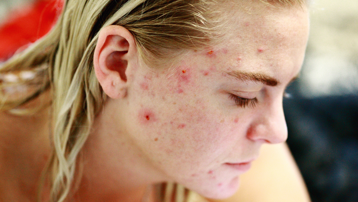 Hormonal Acne
