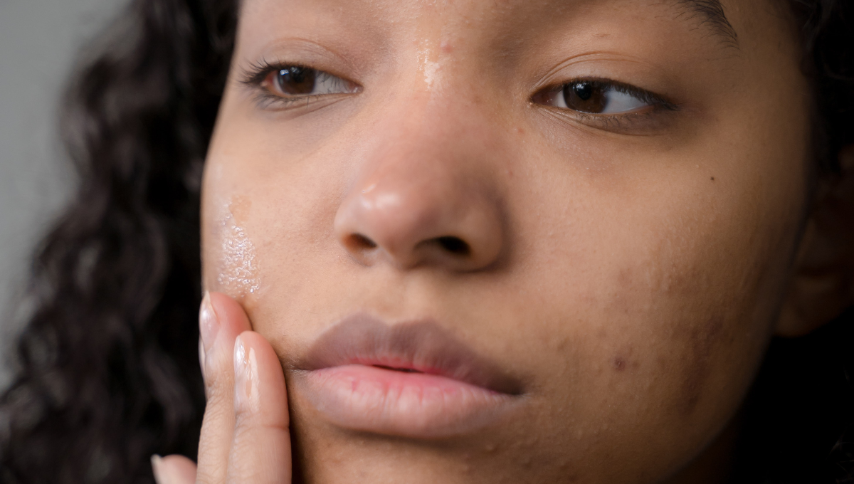 Hormonal Acne: Causes, Symptoms & Treatments