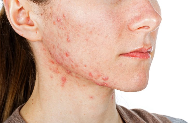 How Dermatologists Treat Hormonal Acne