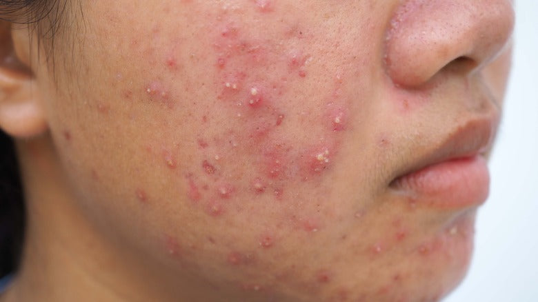 How to Tell If Acne Is Hormonal 