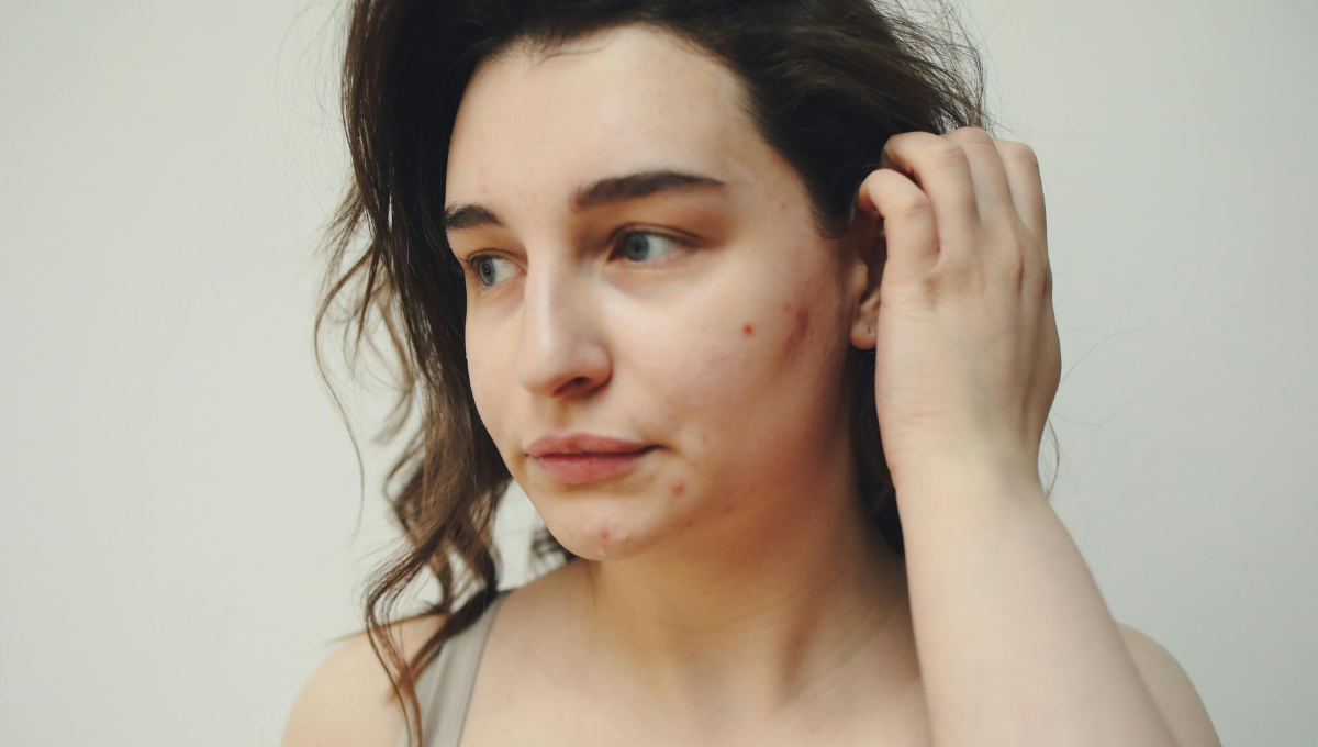 Hygiene Hacks to Beat Hormonal Acne