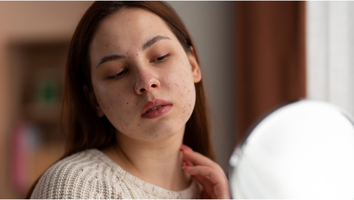 Insulin Resistance & Hormonal Acne