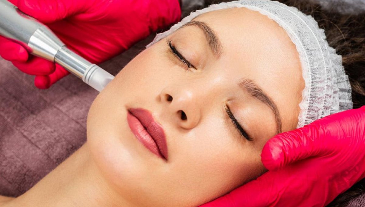 Microneedling 