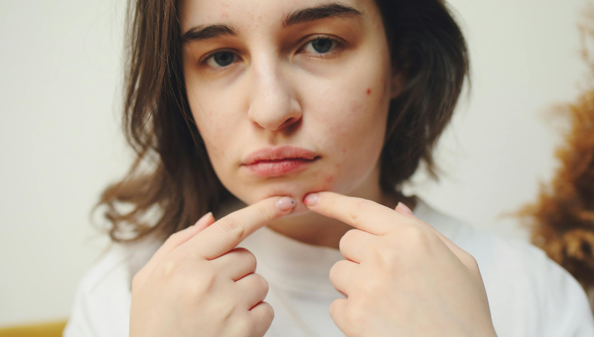 Natural Skincare Tips for Hormonal Acne