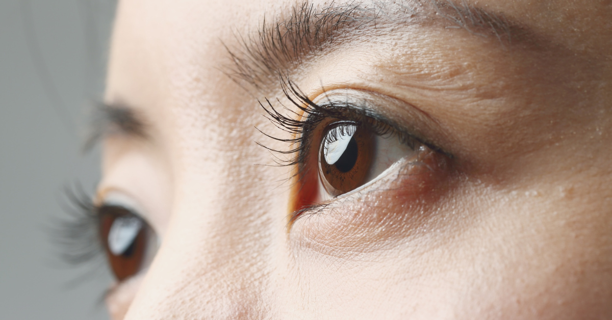 What Causes Puffy Eyes and How to Fix Them