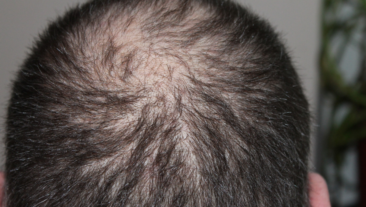 Reverse Hair Loss with PRP Therapy