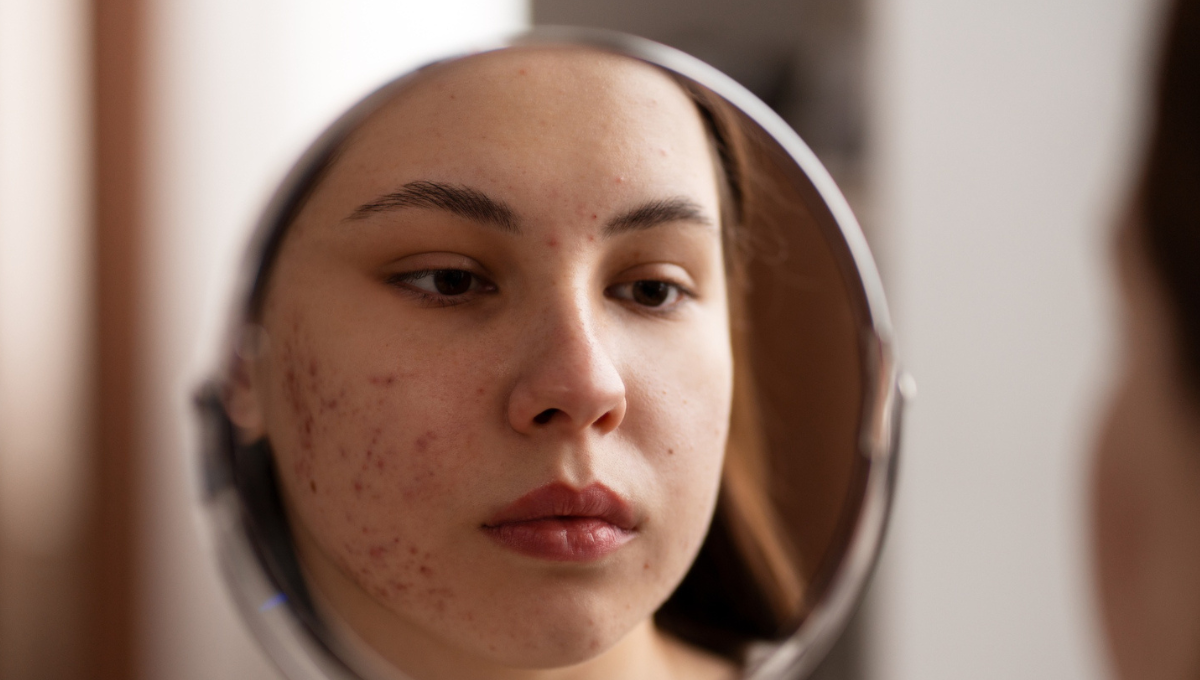 Teenage Acne vs Adult Acne