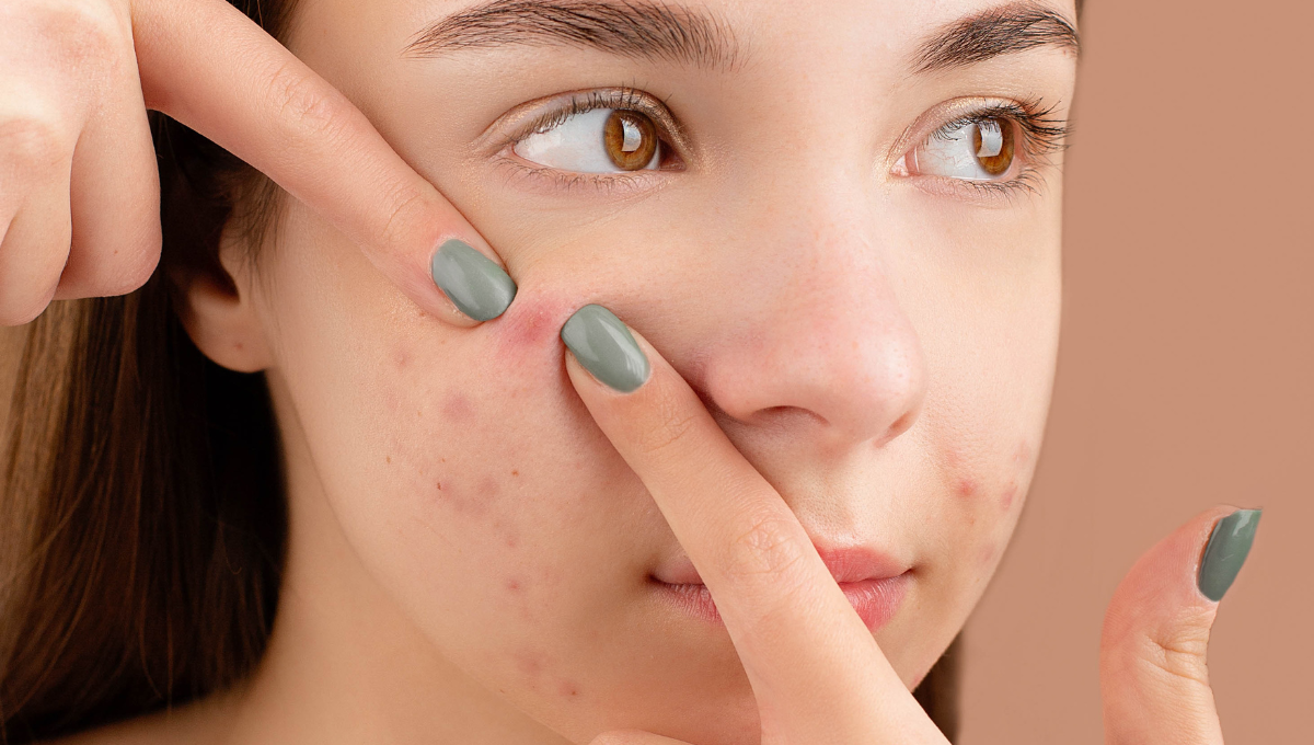 Understanding Cystic Hormonal Acne