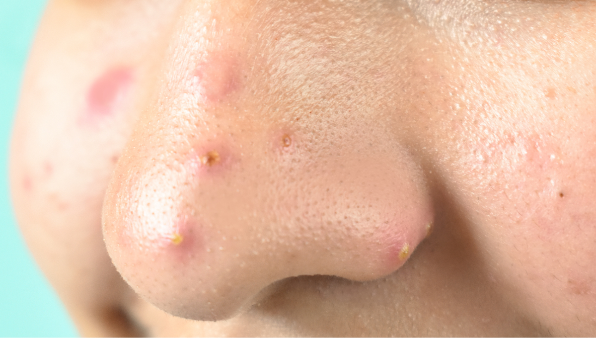 Understanding Hormonal Acne in Men