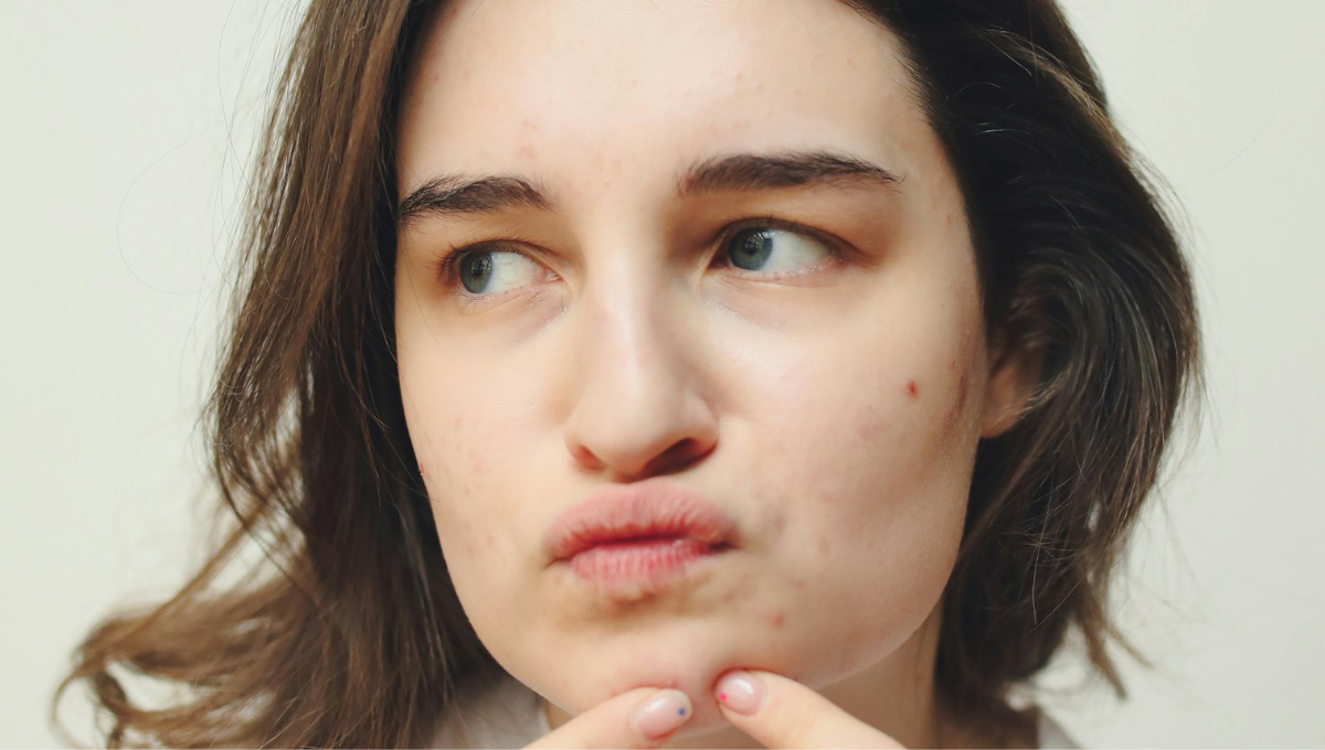 What Chin Acne Reveals About Hormone Imbalance