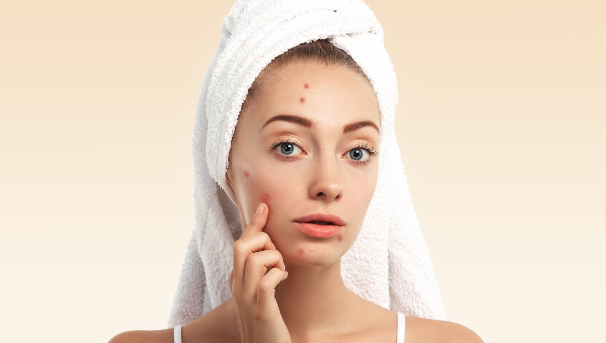 What Are Whiteheads? Causes, Treatments, and Prevention Tips