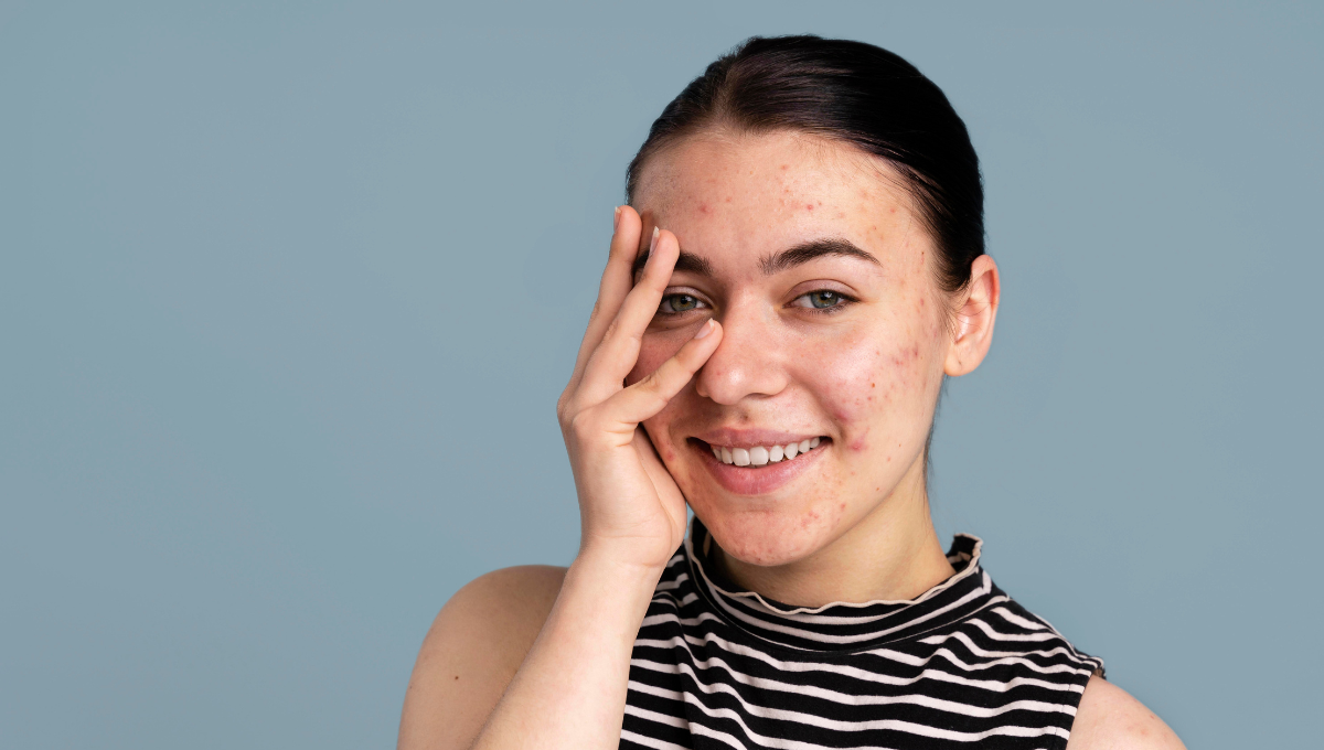  acne scars