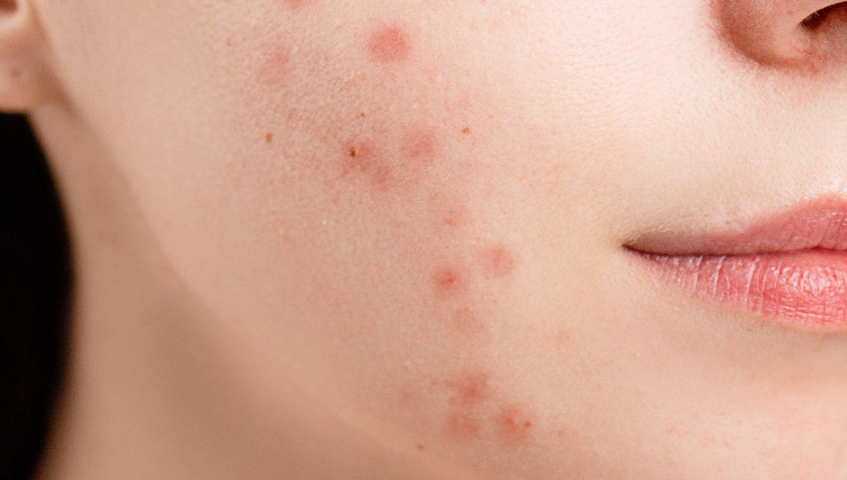 Stubborn Acne