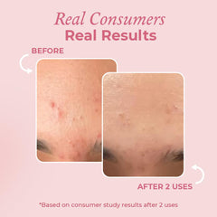 The Pink Foundry Acne Spot Corrector with Salicylic Acid