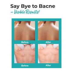 THE LOVE CO. Back Acne Spray