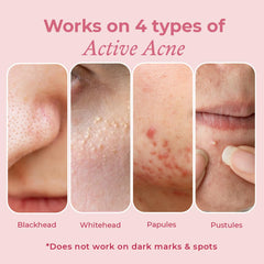 The Pink Foundry Acne Spot Corrector with Salicylic Acid