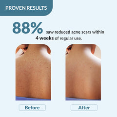 Fixderma Salyzap 2% Salicylic Acid Body Wash