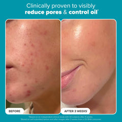 PAULA'S CHOICE SKIN PERFECTING 2% BHA Liquid Salicylic Acid Exfoliant