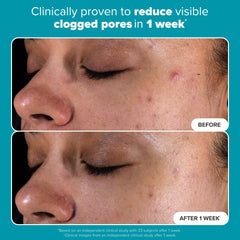PAULA'S CHOICE SKIN PERFECTING 2% BHA Liquid Salicylic Acid Exfoliant